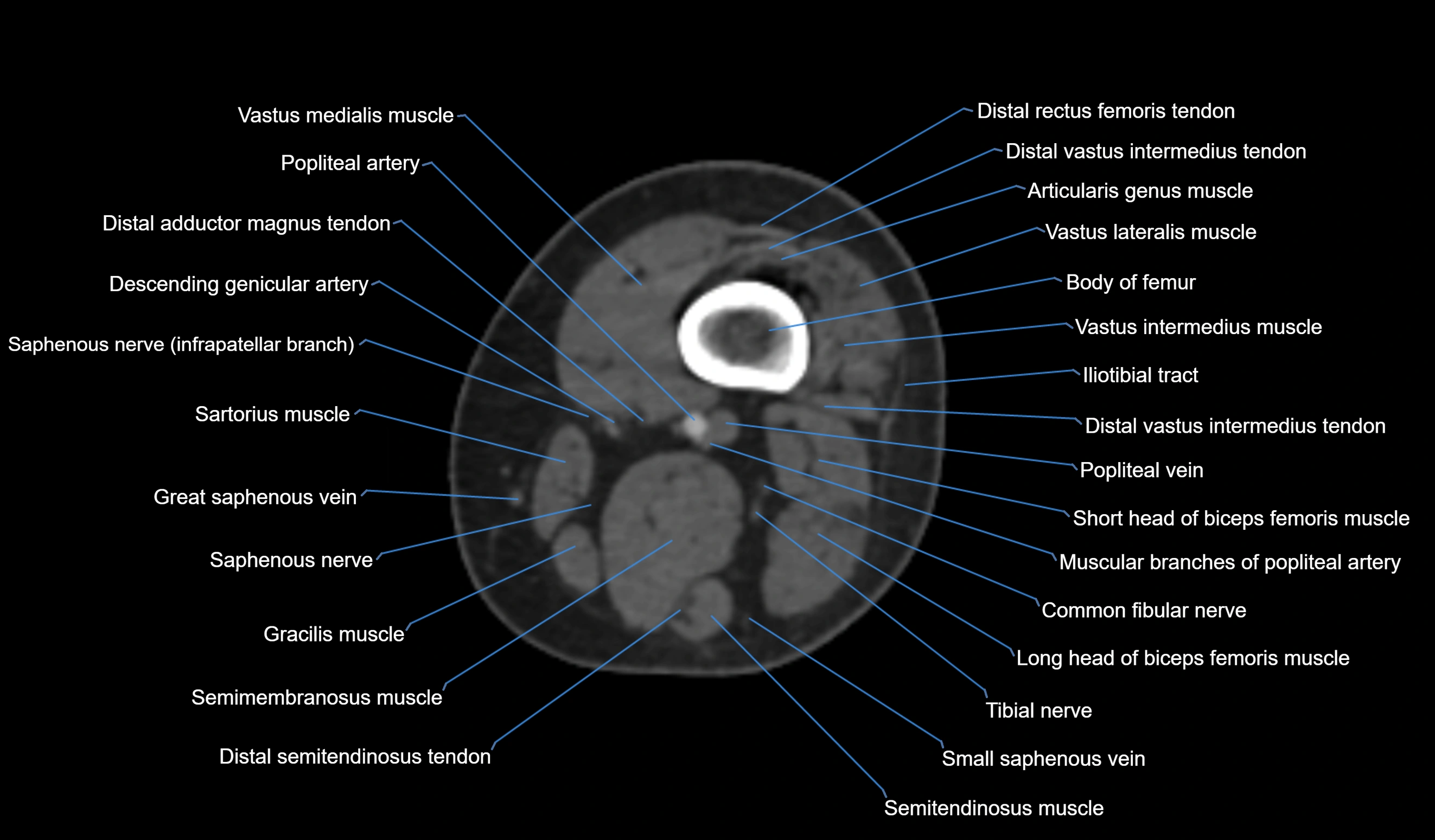 CT knee axial cross sectional anatomy labelled image-00002.webp